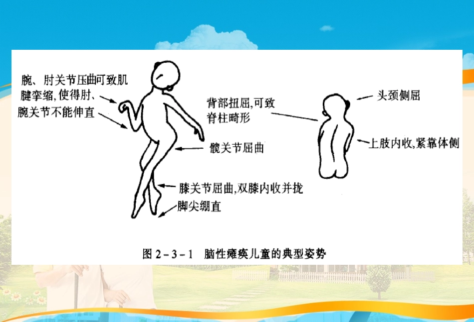 小儿脑瘫的康复训练_第3页