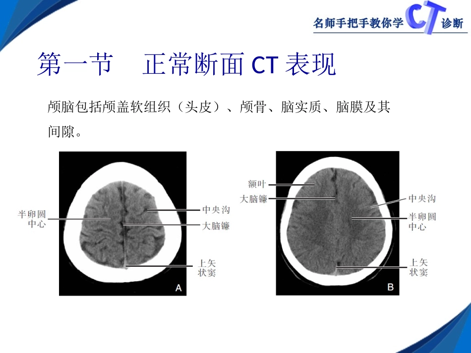 第二章__颅_脑CT_第2页