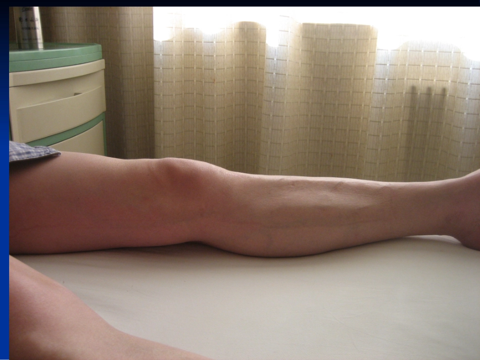 OA 膝外翻_第3页