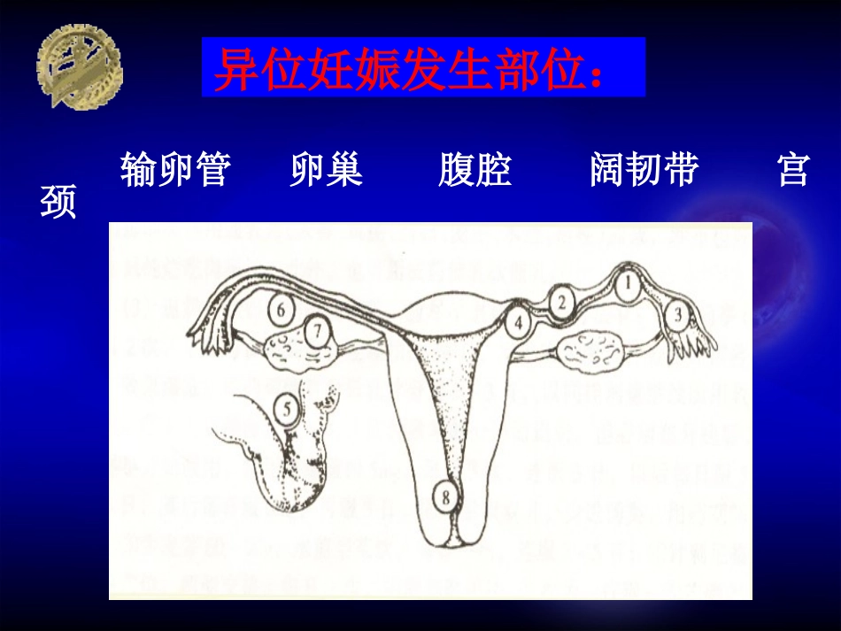 异位妊娠ep--new_第2页