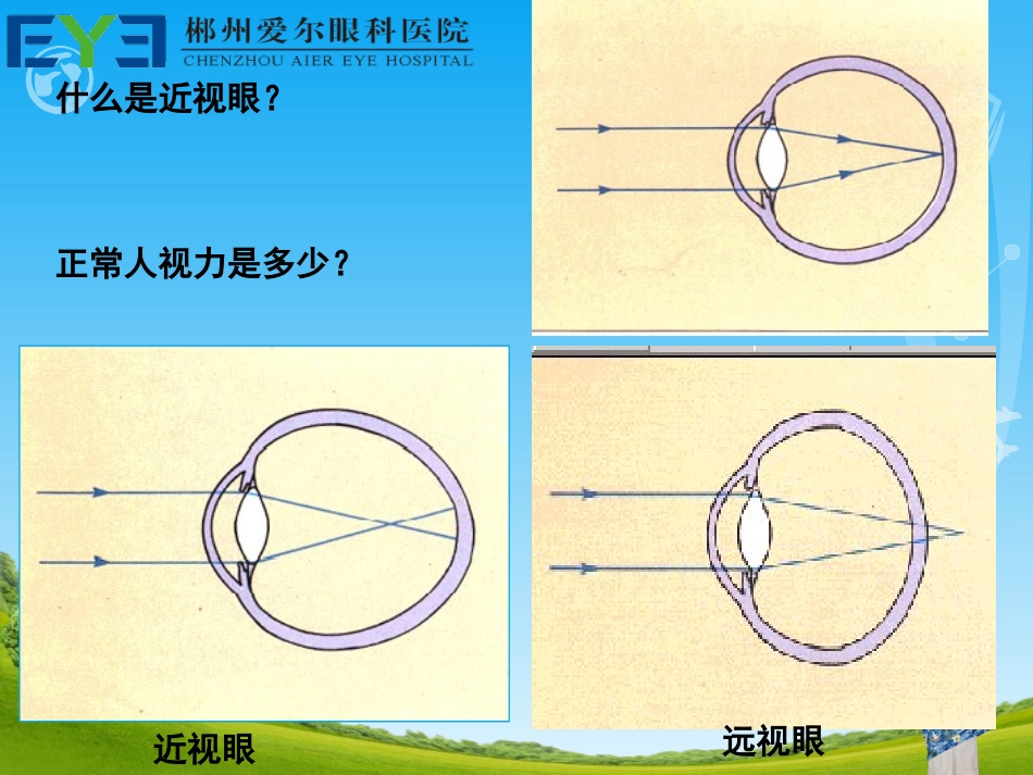 屈光不正矫正方法_第3页