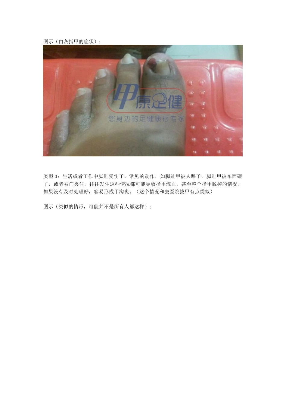 甲沟炎的治疗方法与效果对比_第3页