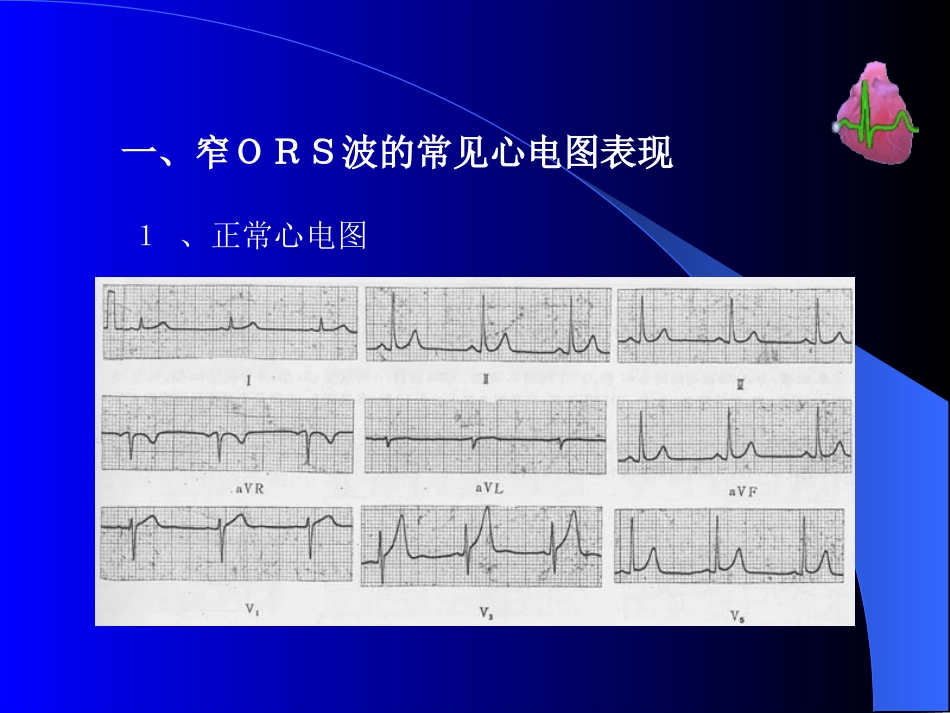 常见心电图谱_第3页