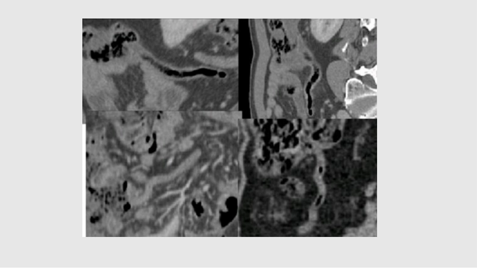 阑尾炎影像学_第3页