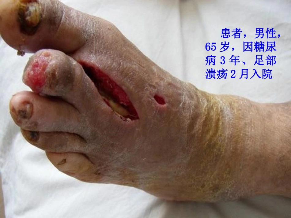 糖尿病足进展(图片)_第2页