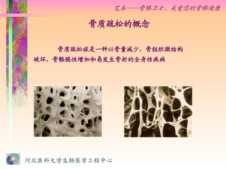 骨质疏松症及伊班膦酸钠的应用_第2页