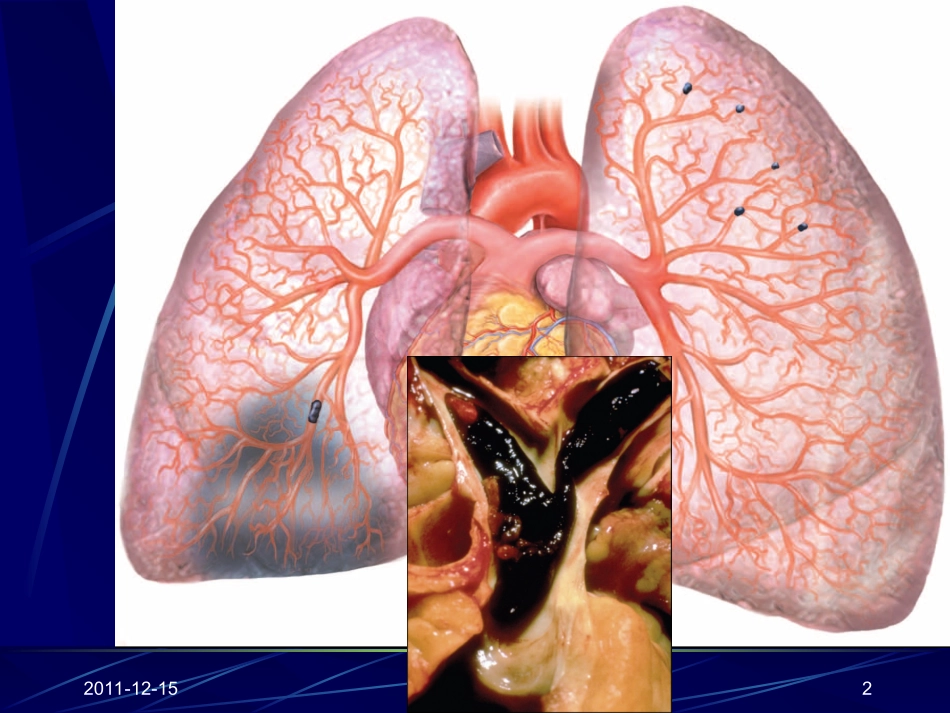 急性肺血栓栓塞症_第2页