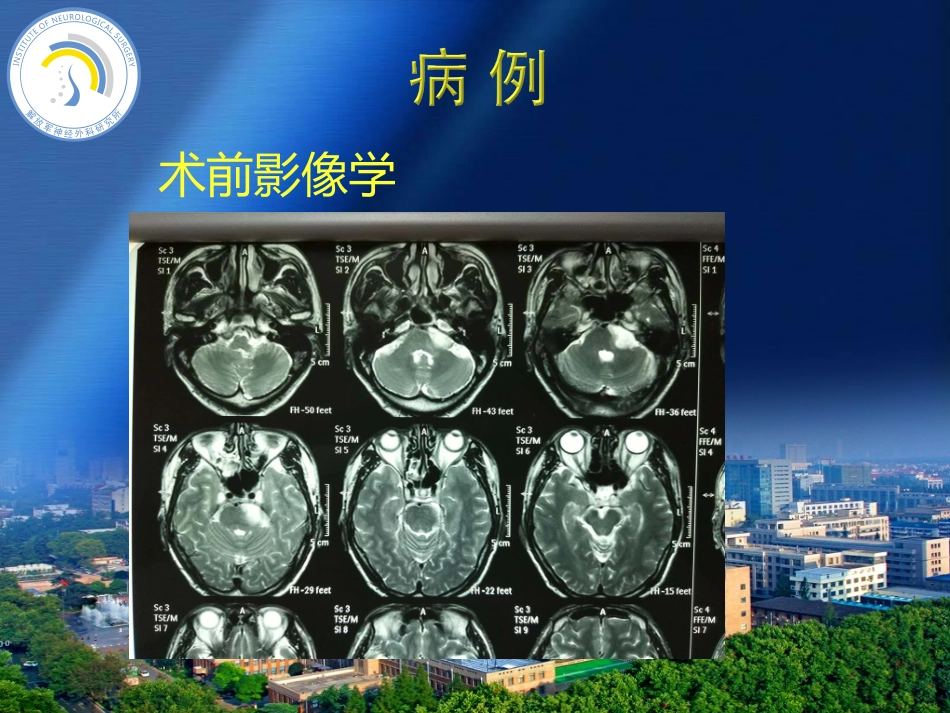 桥小脑角胶质瘤_第3页