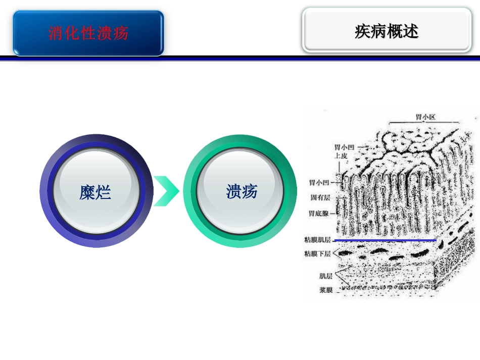消化性溃疡护校_第3页