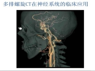神经内科交流学习课件