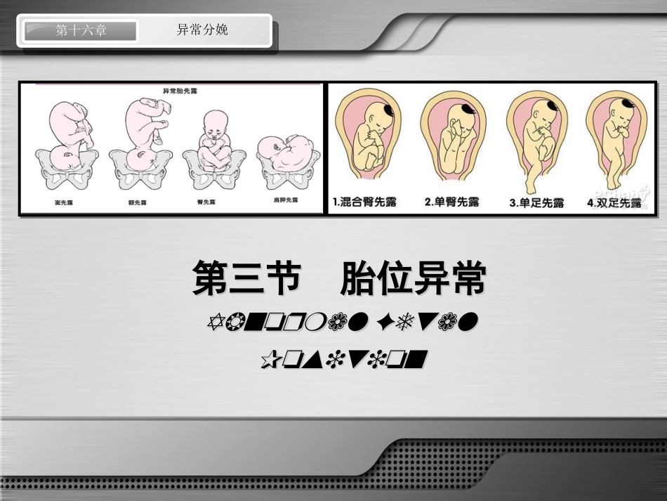 异常分娩-胎位异常_第2页