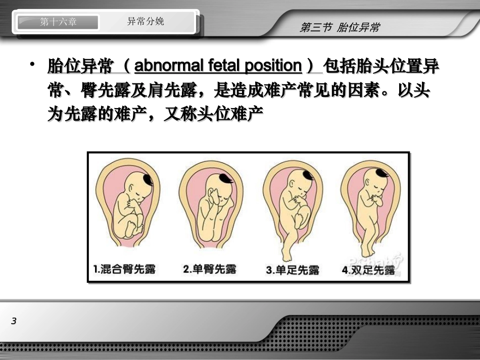 异常分娩-胎位异常_第3页