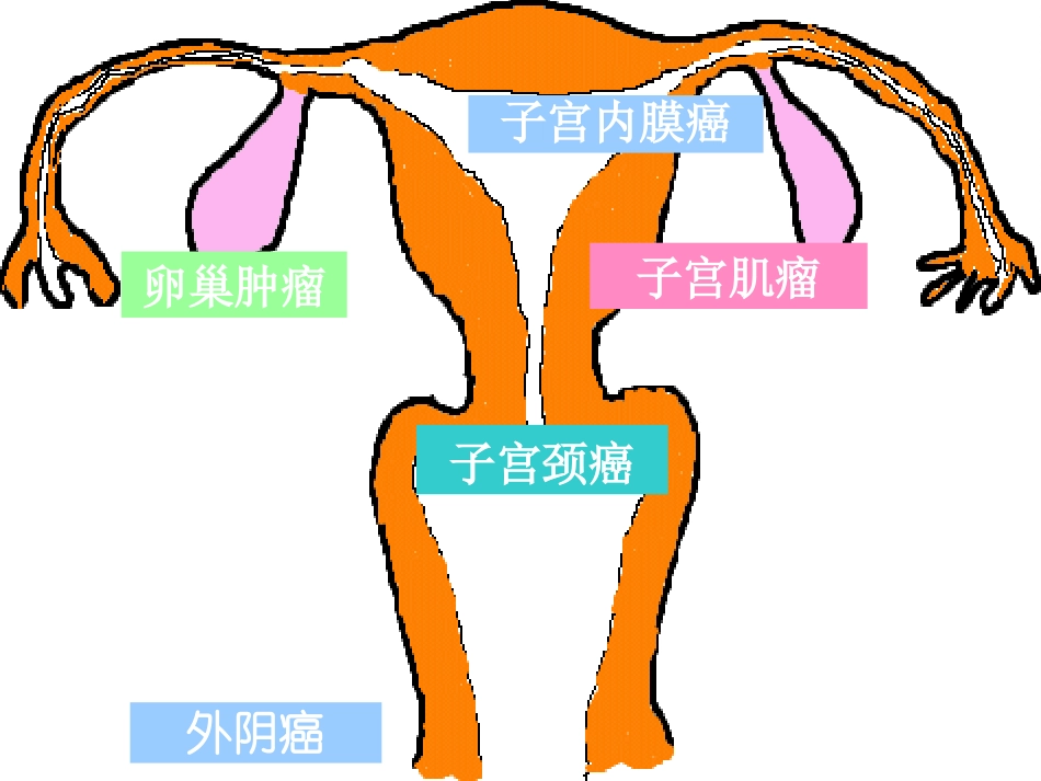 子宫颈癌-妇科知识_第1页