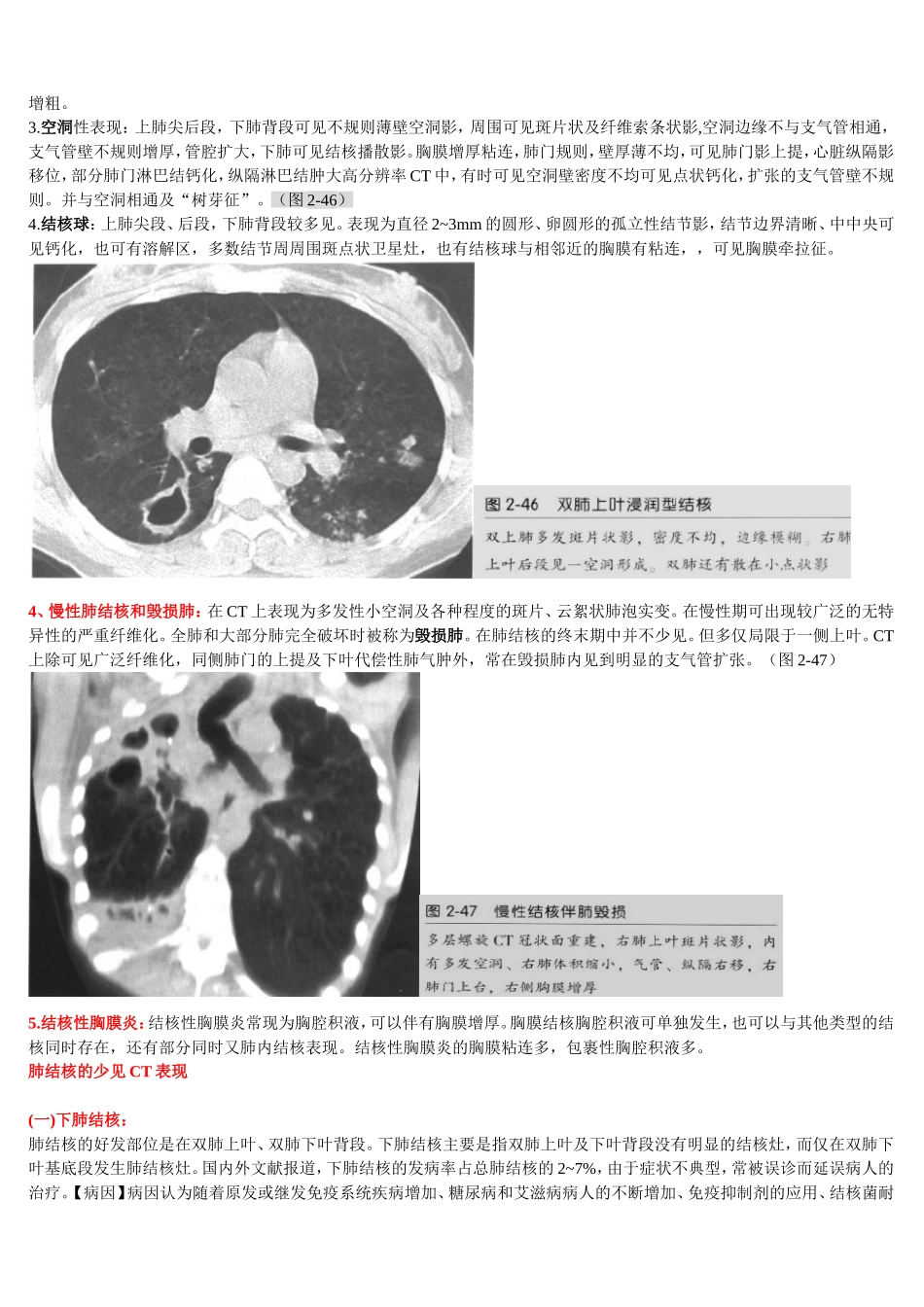 肺结核少见CT表现_第2页
