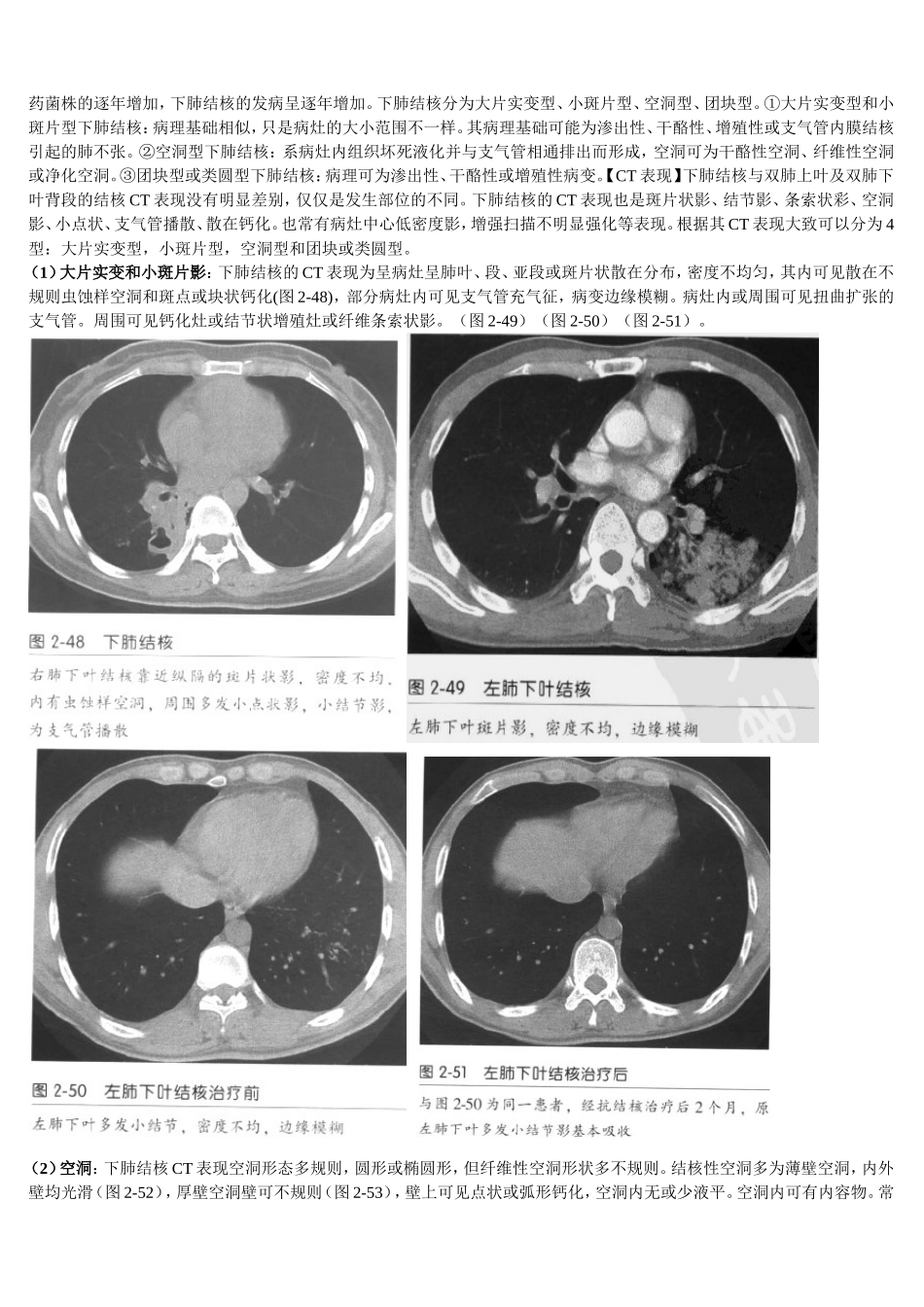 肺结核少见CT表现_第3页