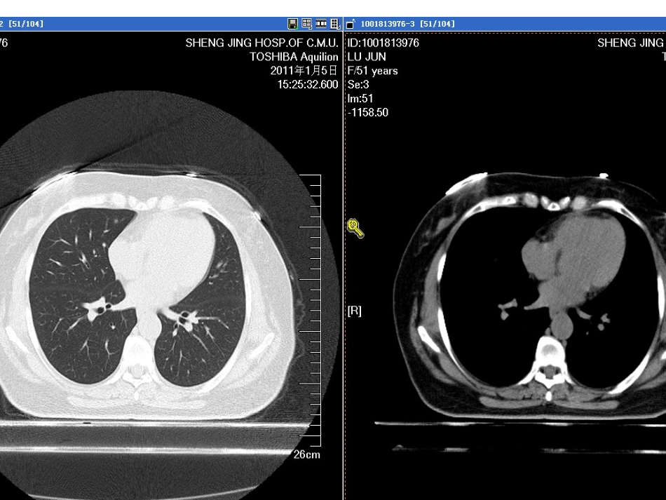 NCCN肺癌筛查指南2012版_第2页
