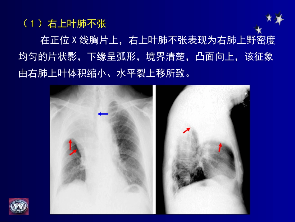 影像学-呼吸基础病变_第3页