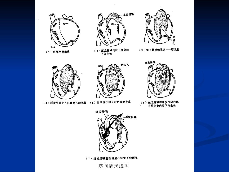 房间隔缺损和动脉导管未闭_第3页