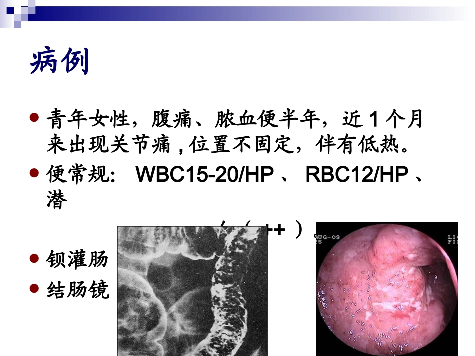 炎症性肠病.ppt(7年制)_第2页