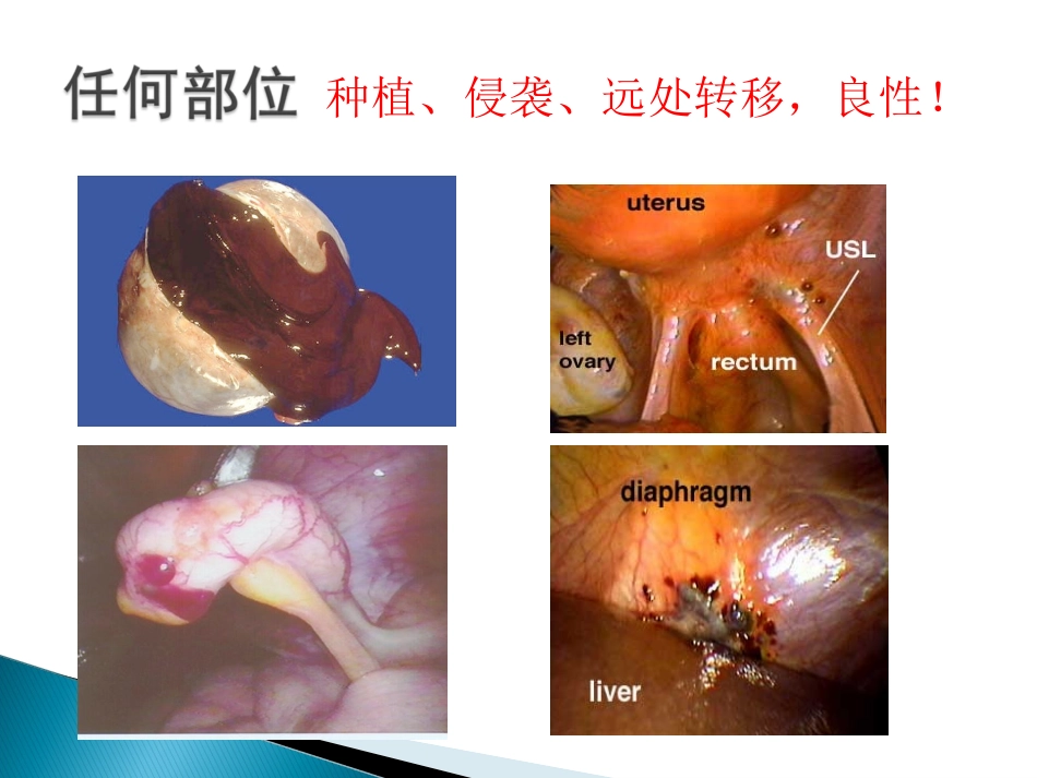 子宫内膜异位症2016_第3页