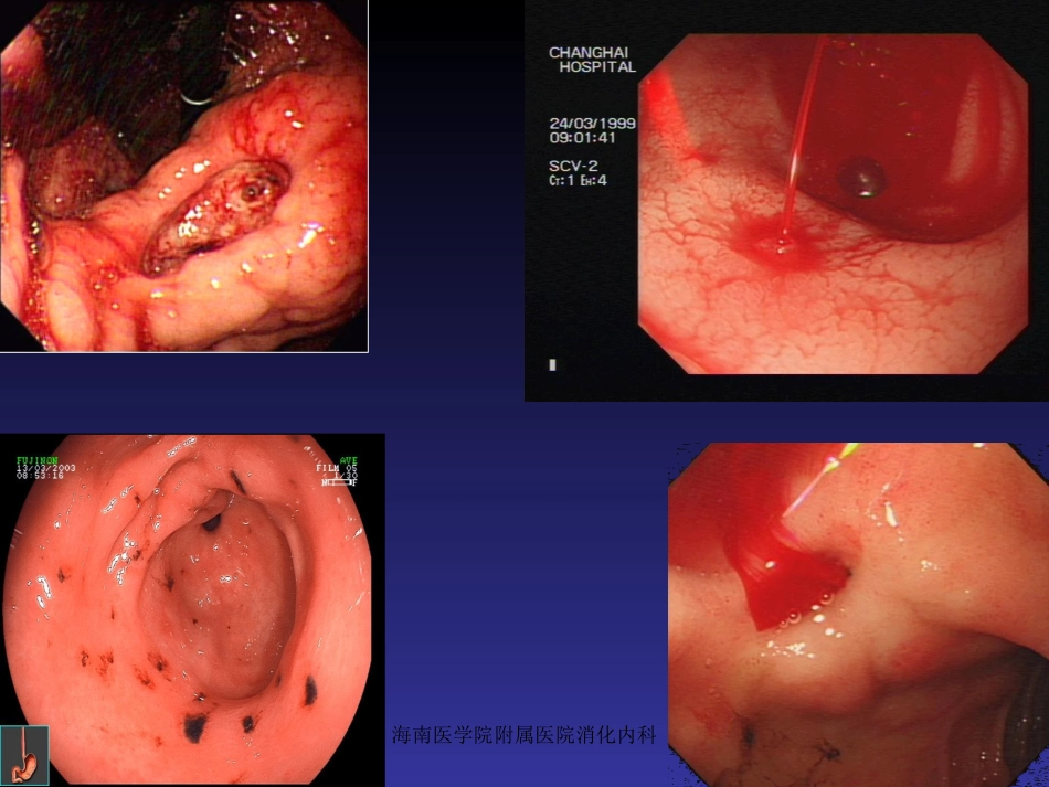胃十二指肠出血_第2页
