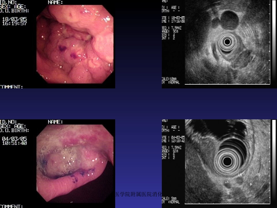 胃十二指肠出血_第3页