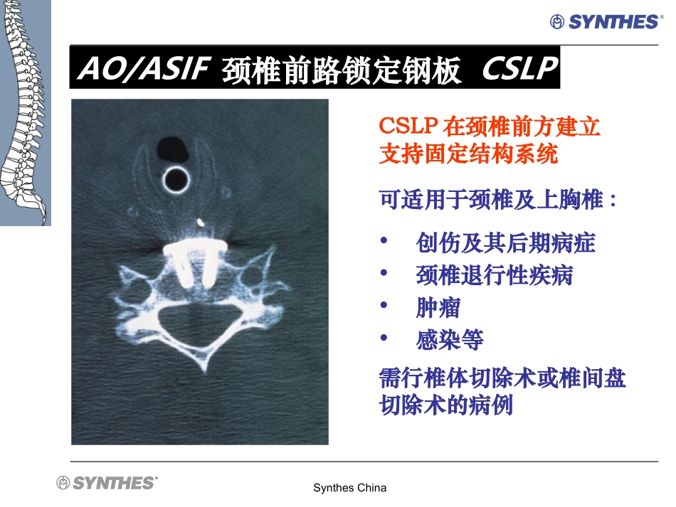 颈椎前路锁定钢板  CSLP-NA-SS_第2页