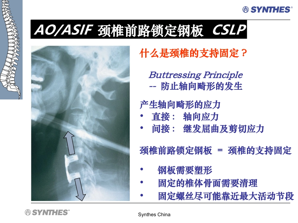 颈椎前路锁定钢板  CSLP-NA-SS_第3页