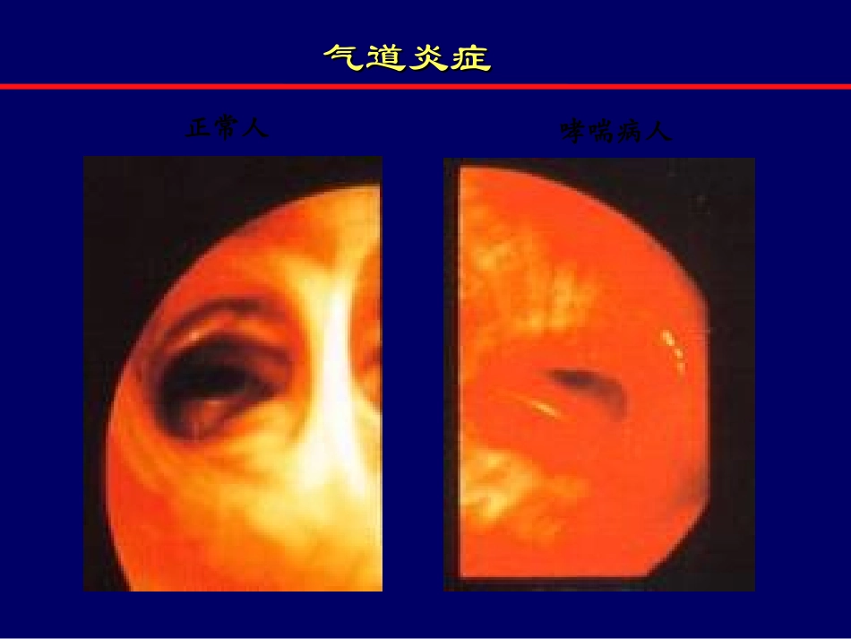 儿童重症哮喘_第3页