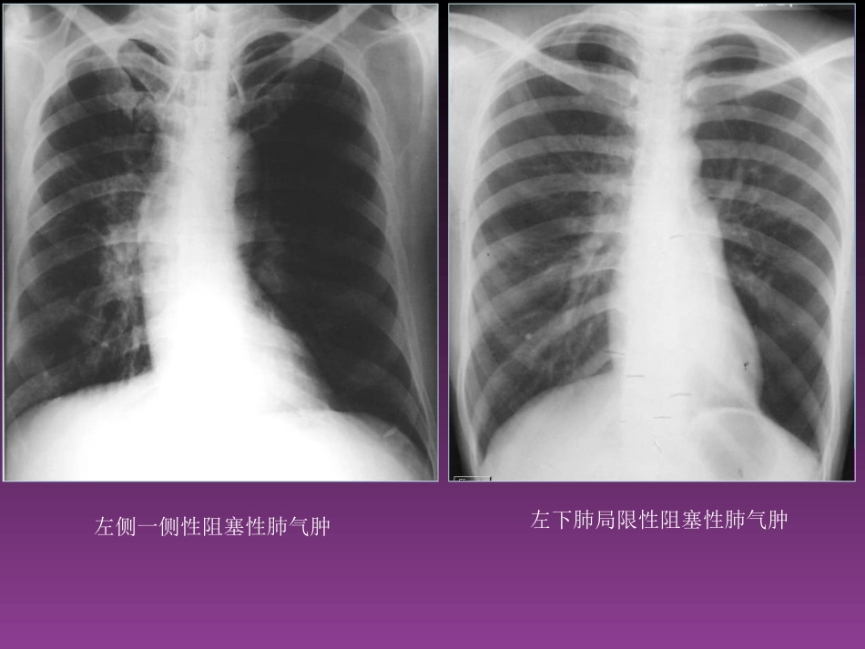 呼吸系统X线基本病变_第3页
