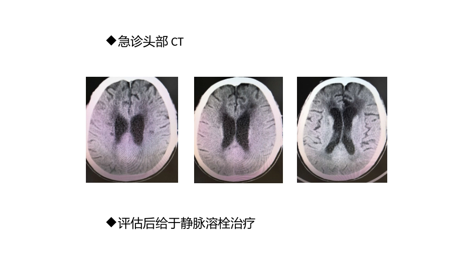 关于静脉溶栓后发生早期神经功能恶化原因探讨_第3页