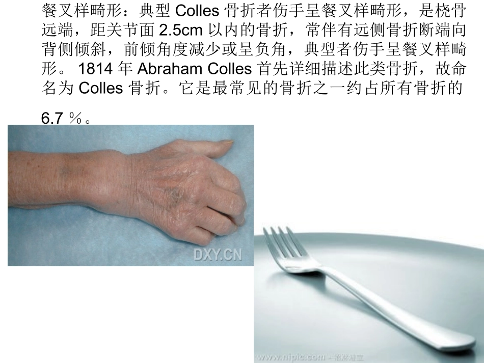 骨科特殊体征_第3页