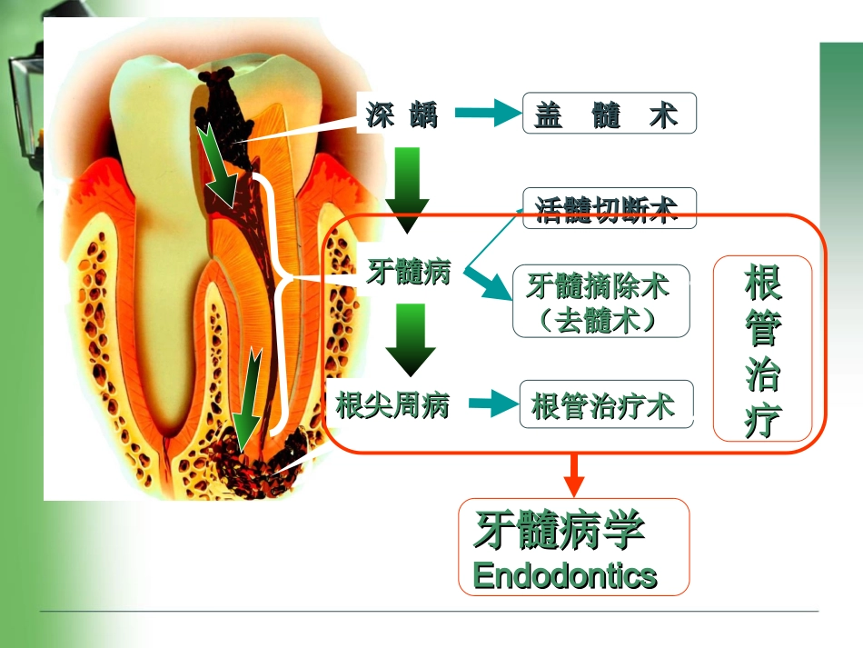 根管治疗rct_第2页