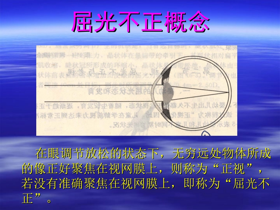 屈光不正矫治_第2页