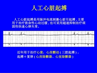人工心脏起搏03417ppt