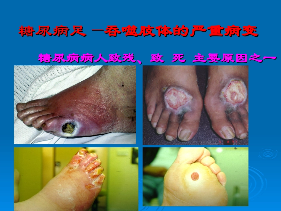 糖尿病足特色治疗_第3页