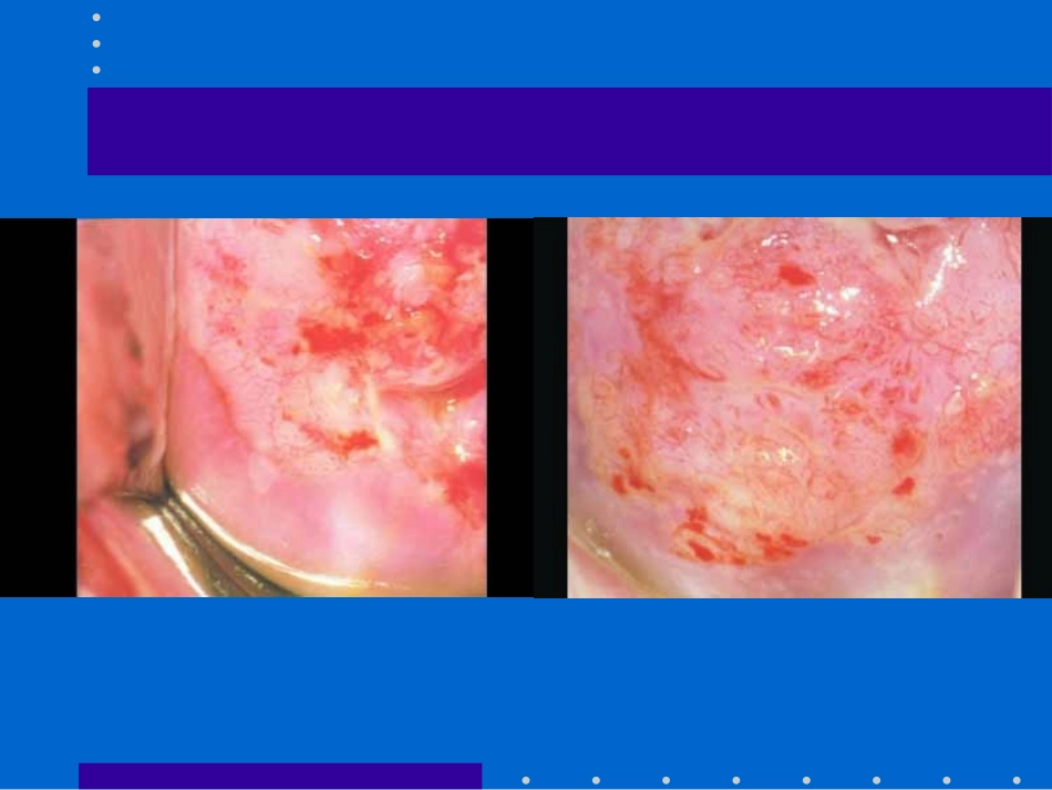 徐爱娣CIN-的诊治_第3页