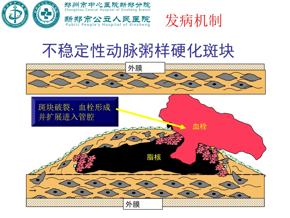急性ST段抬高型心肌梗死-2017指南_第3页