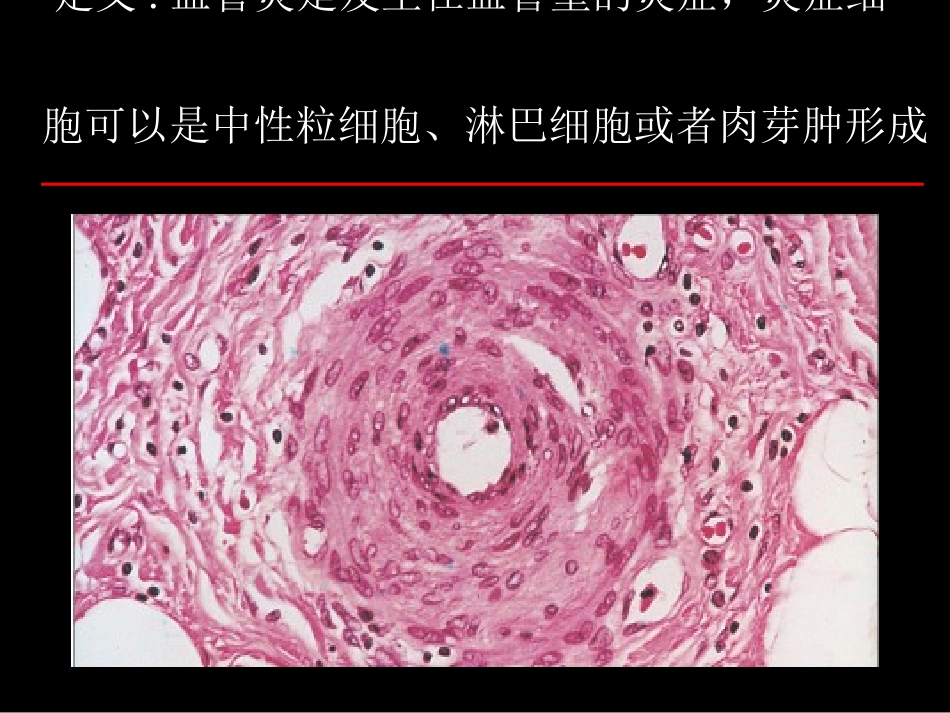 ANCA相关小血管炎0-(AAV)amx2_第3页