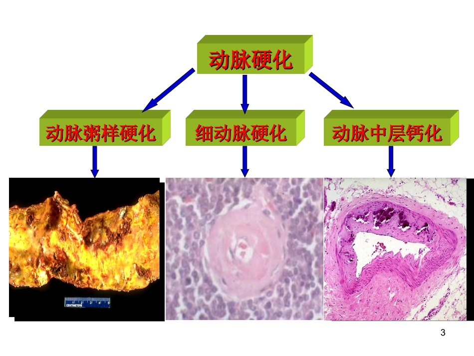 动脉粥样硬化_第3页