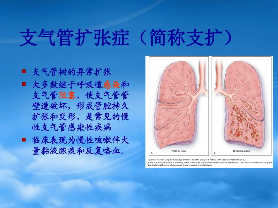 支气管扩张bronchiectasis_第2页