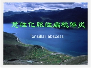 急性化脓性扁桃体炎