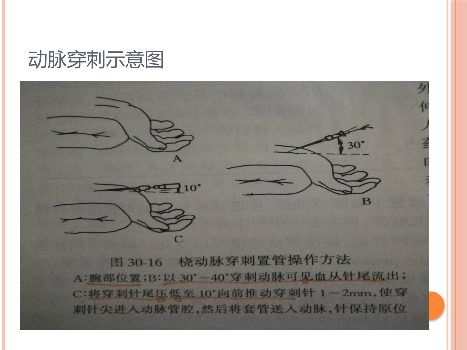动脉穿刺置管与血压测定_第3页