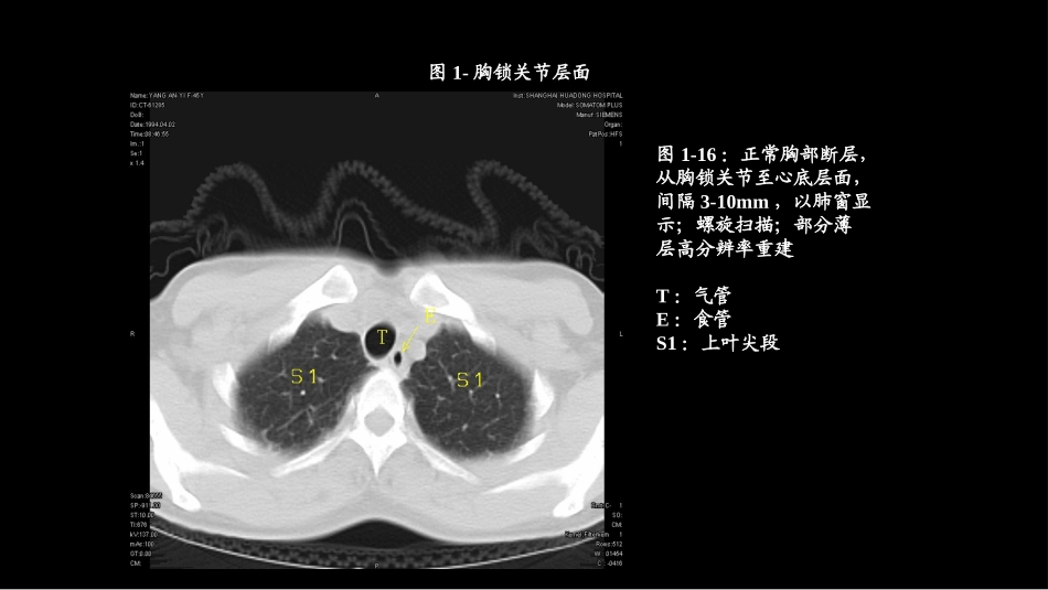 CT肺叶分段及纵膈淋巴结分组_第2页