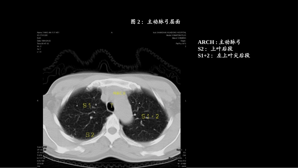 CT肺叶分段及纵膈淋巴结分组_第3页