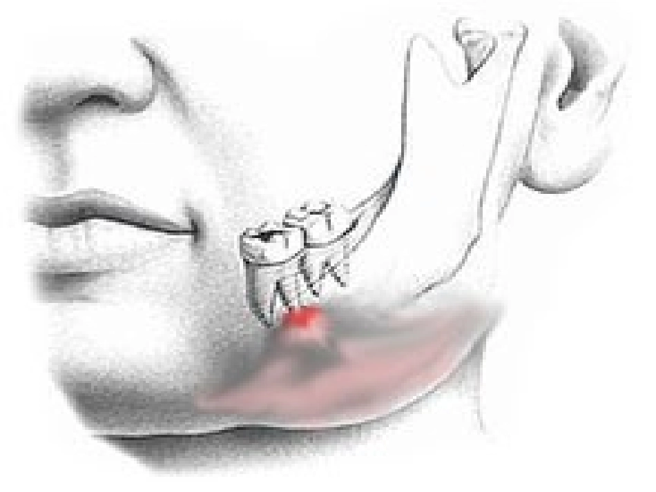 项目牙髓病及-根尖周病_第1页