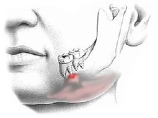 项目牙髓病及-根尖周病