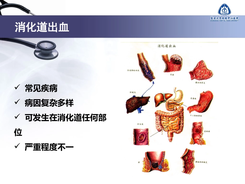 不明原因消化道出血的诊疗进展_第2页