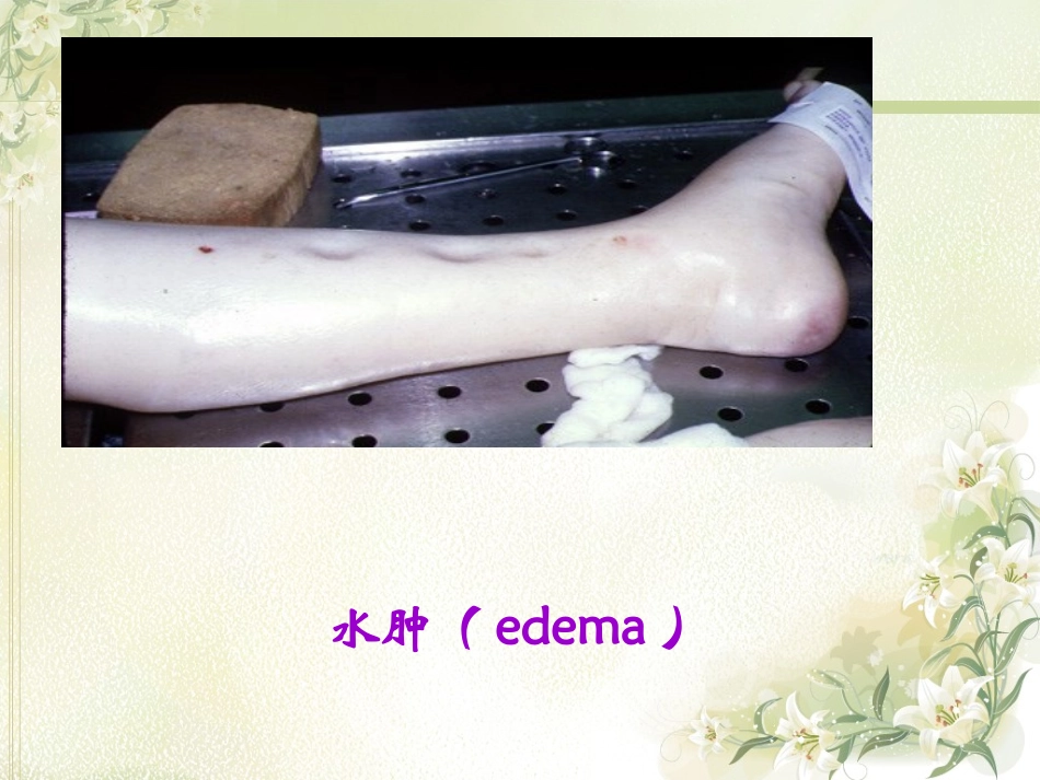 水盐3-水肿_第2页