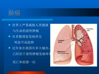 肺癌(本科)2